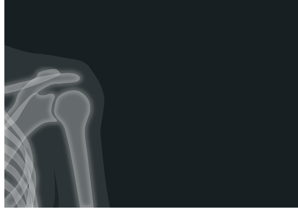 osteoporosis